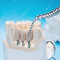 видове зъбни импланти - 27926 комбинации