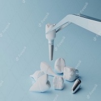 видове зъбни импланти - 37174 промоции