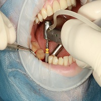 видове зъбни импланти - 44012 постижения