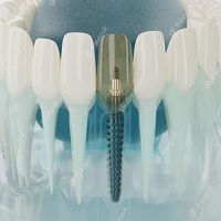 видове зъбни импланти - 69813 типа