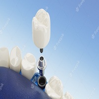 видове зъбни импланти - 24315 типа