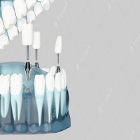 видове зъбни импланти - 66643 снимки