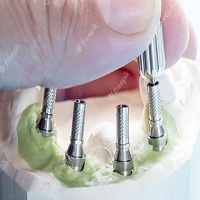 видове зъбни импланти - 17347 оферти