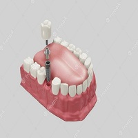 видове зъбни импланти - 12366 новини