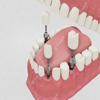 видове зъбни импланти - 77747 бестселъри