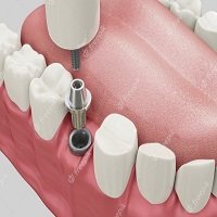 видове зъбни импланти - 72253 комбинации