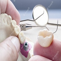 видове зъбни импланти - 51247 типа