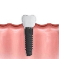видове зъбни импланти - 71794 предложения