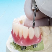 видове зъбни импланти - 16120 отстъпки